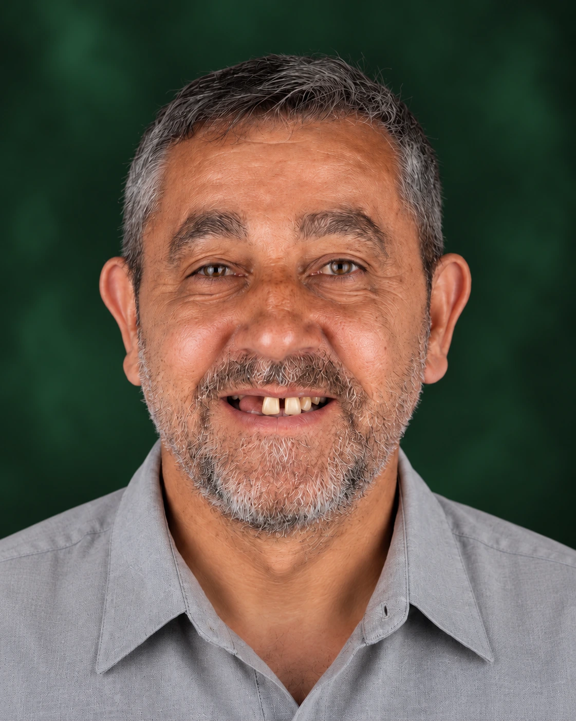 قبل از درمان زیبایی دندان