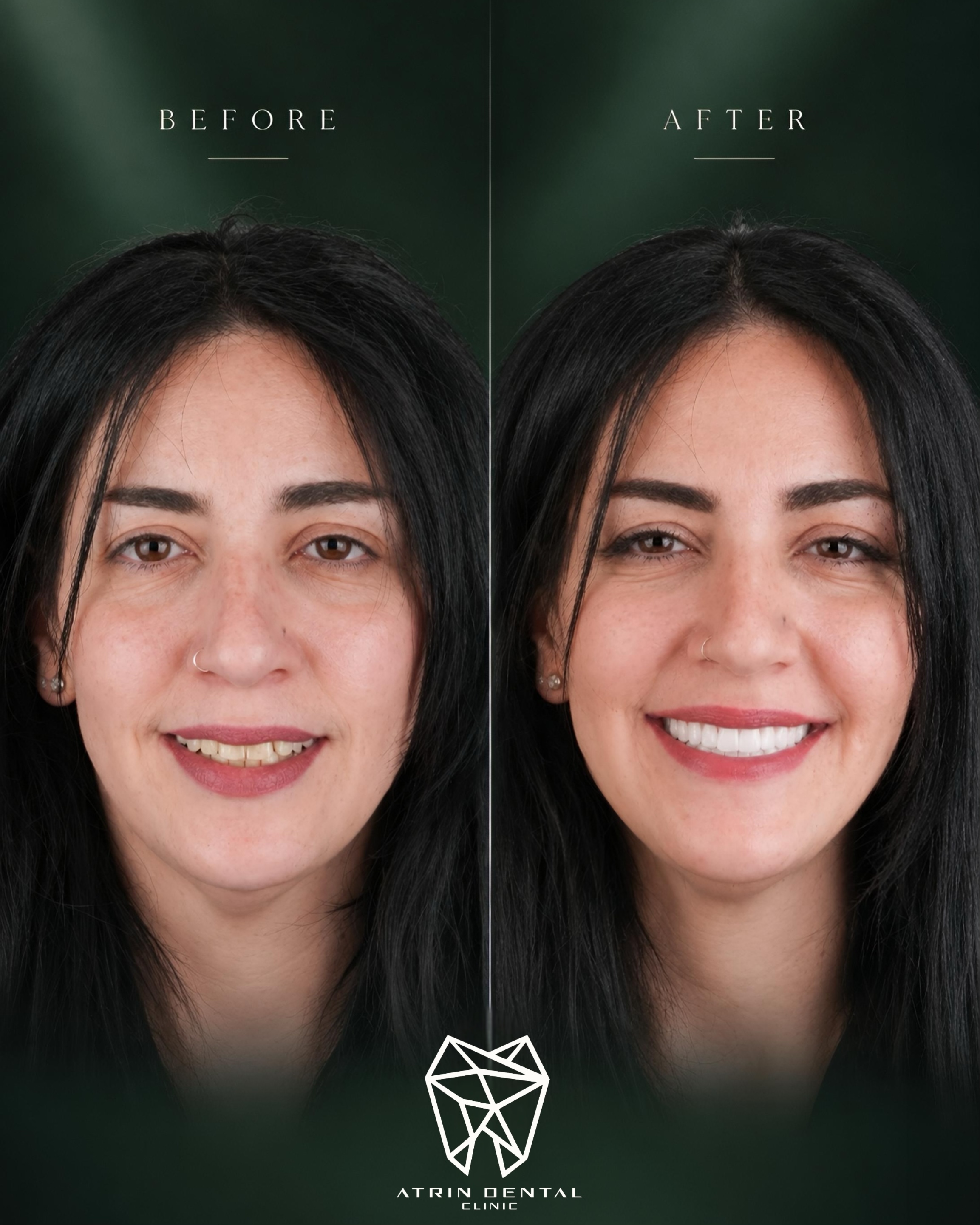 تصویری از قبل و بعد اصلاح طرح لبخند با لمینیت سرامیکی در کلینیک دندانپزشکی آترین، با فرم طبیعی و شفافیت بالا.